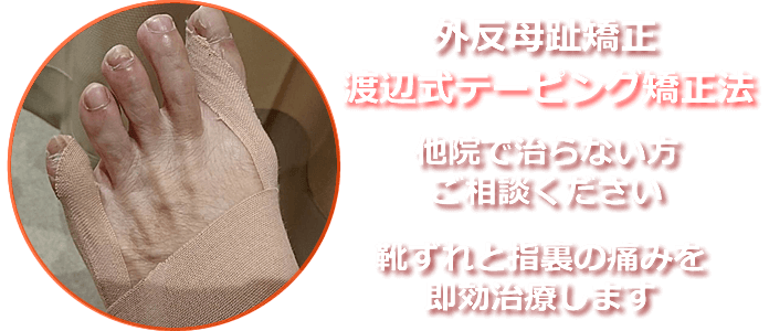 駒沢で外反母趾矯正は、アッシュ整骨院にお任せください。他店では治らなかった外反母趾も、当院の院長が開発・発明した「渡辺式テーピング矯正法」で、即効治療します。筋肉の膜を治療後、手作りの独自手法によりテーピングで矯正し靴ずれと指裏の痛みを改善します。